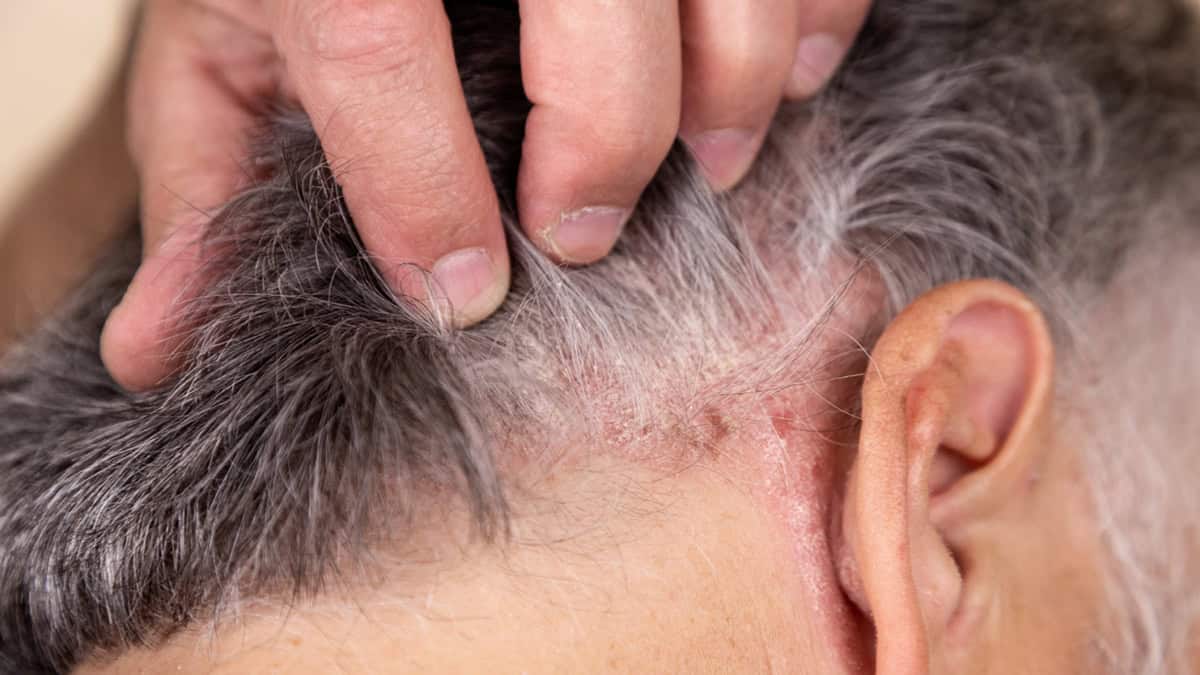 Everything You Need to Know About Zoryve (Roflumilast) Foam