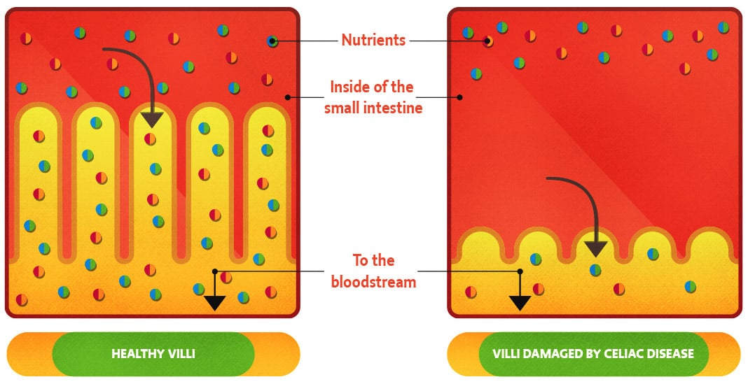 Healthy And Damaged Villi