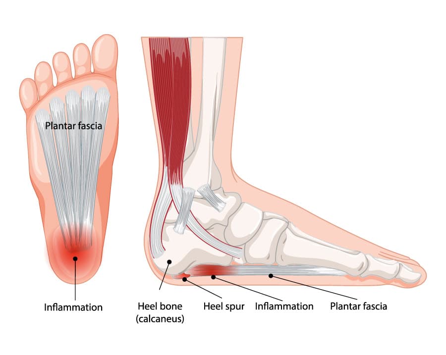 Plantar Fasciitis